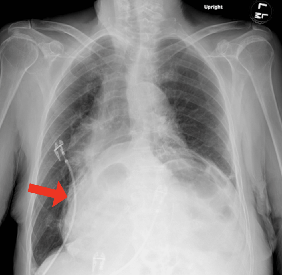bpc 157 hiatal hernia Breaking Boundaries: A Case Report of Giant Hiatal Hernia Housing Pancreas,  Stomach, Small Bowel, and Colon