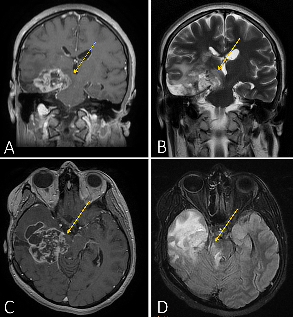 Cranial Mri Anatomy