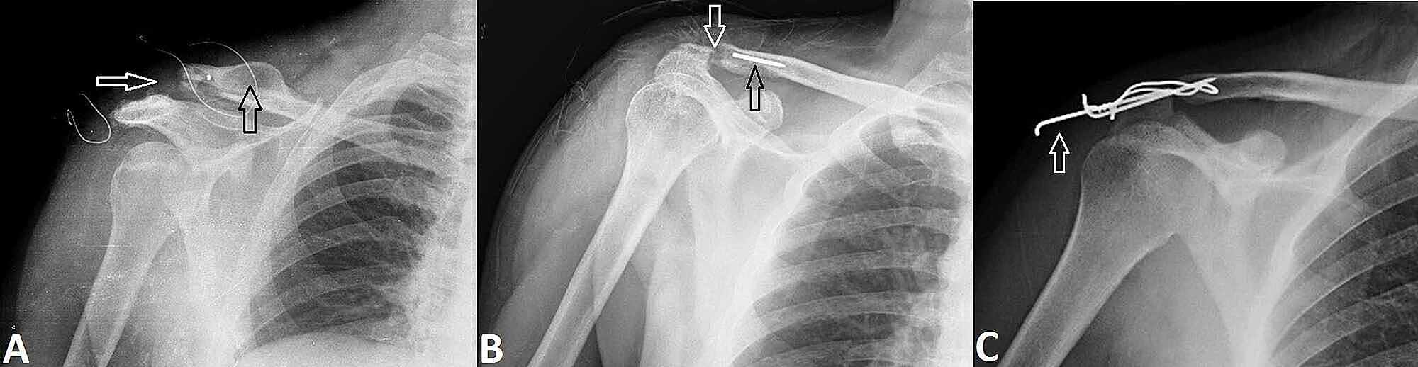 Cureus | Midterm Results of Tension Band Wiring Technique for Acute ...