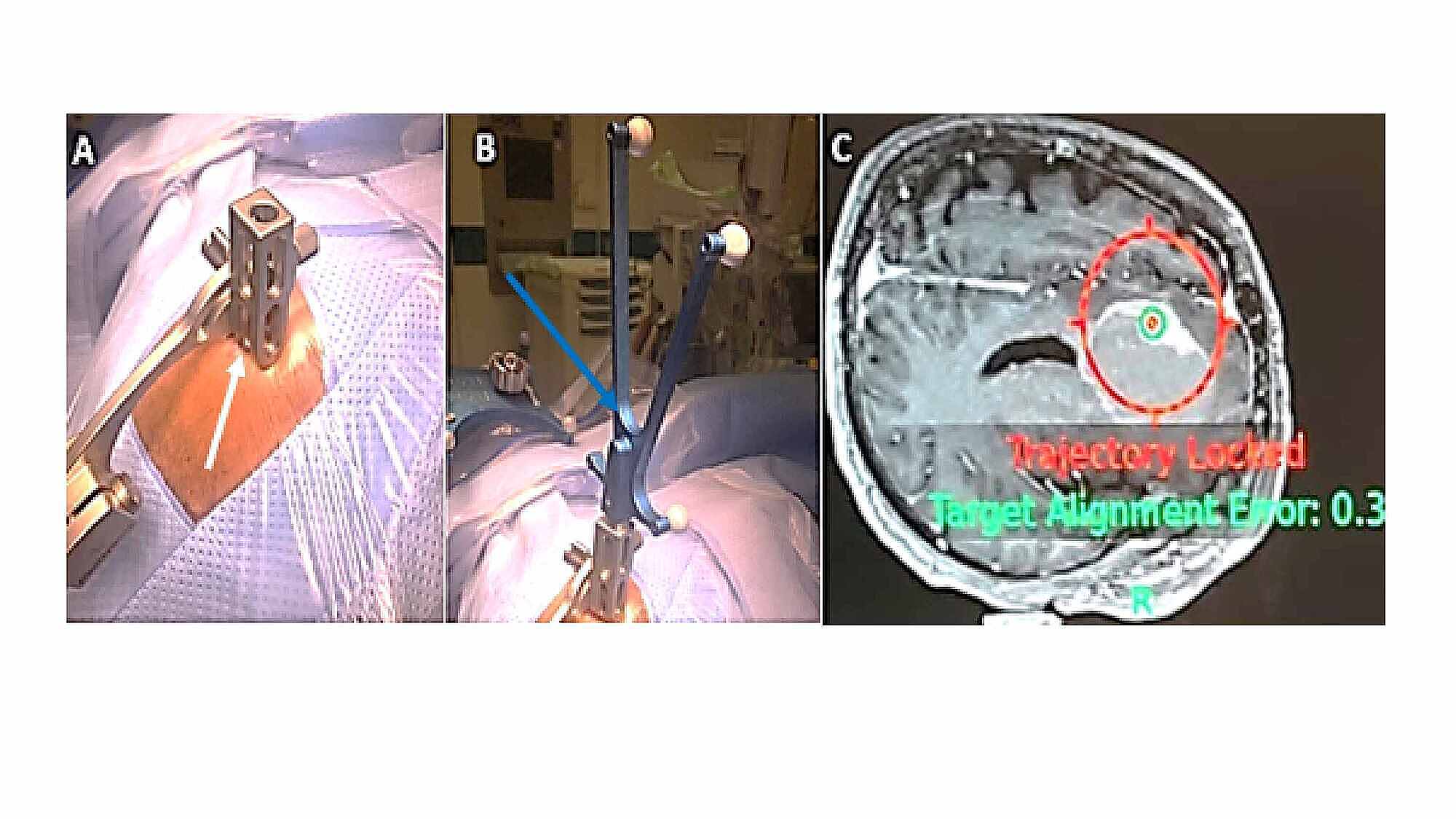 Cureus | A Simple Modified Technique For Frameless Brain Lesion Biopsy