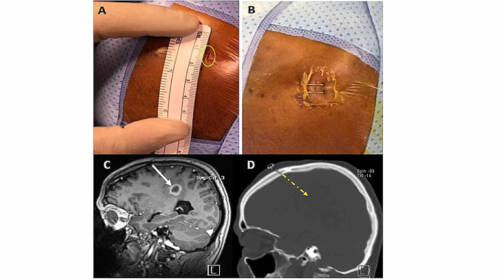 Cureus A Simple Modified Technique for Frameless Brain Lesion Biopsy