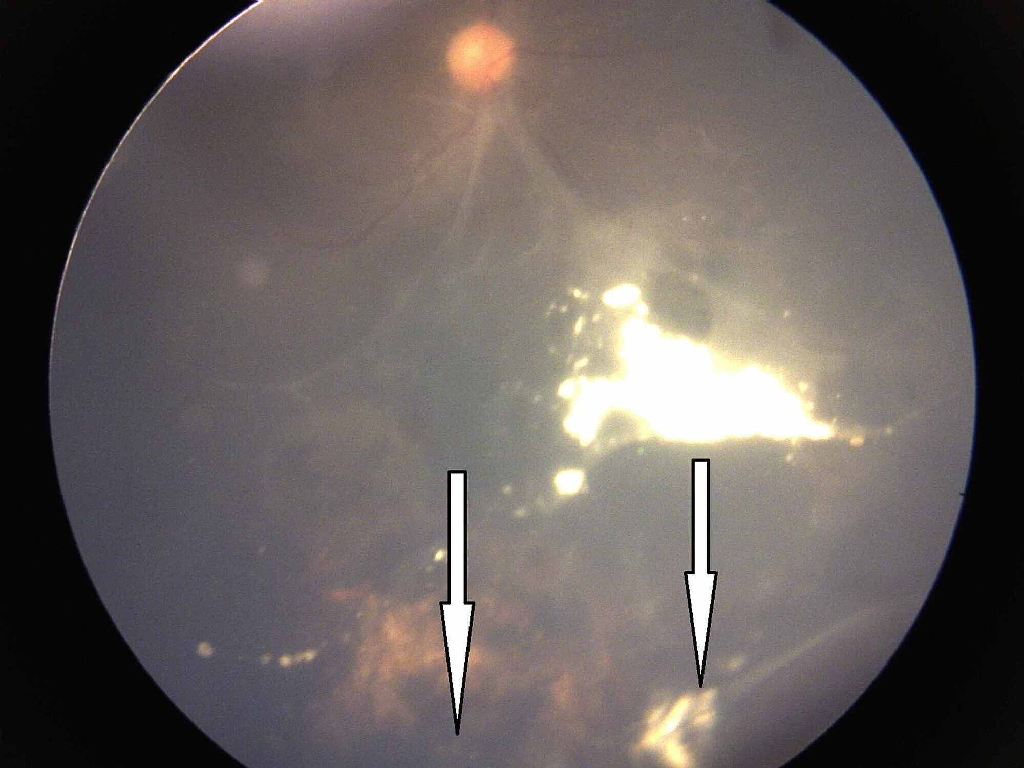 Cureus of Group D Retinoblastoma With Resistant Vitreous