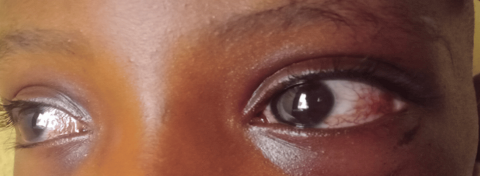 Ataxia-Telangiectasia in Resource-Limited Settings: A Diagnostic Challenge