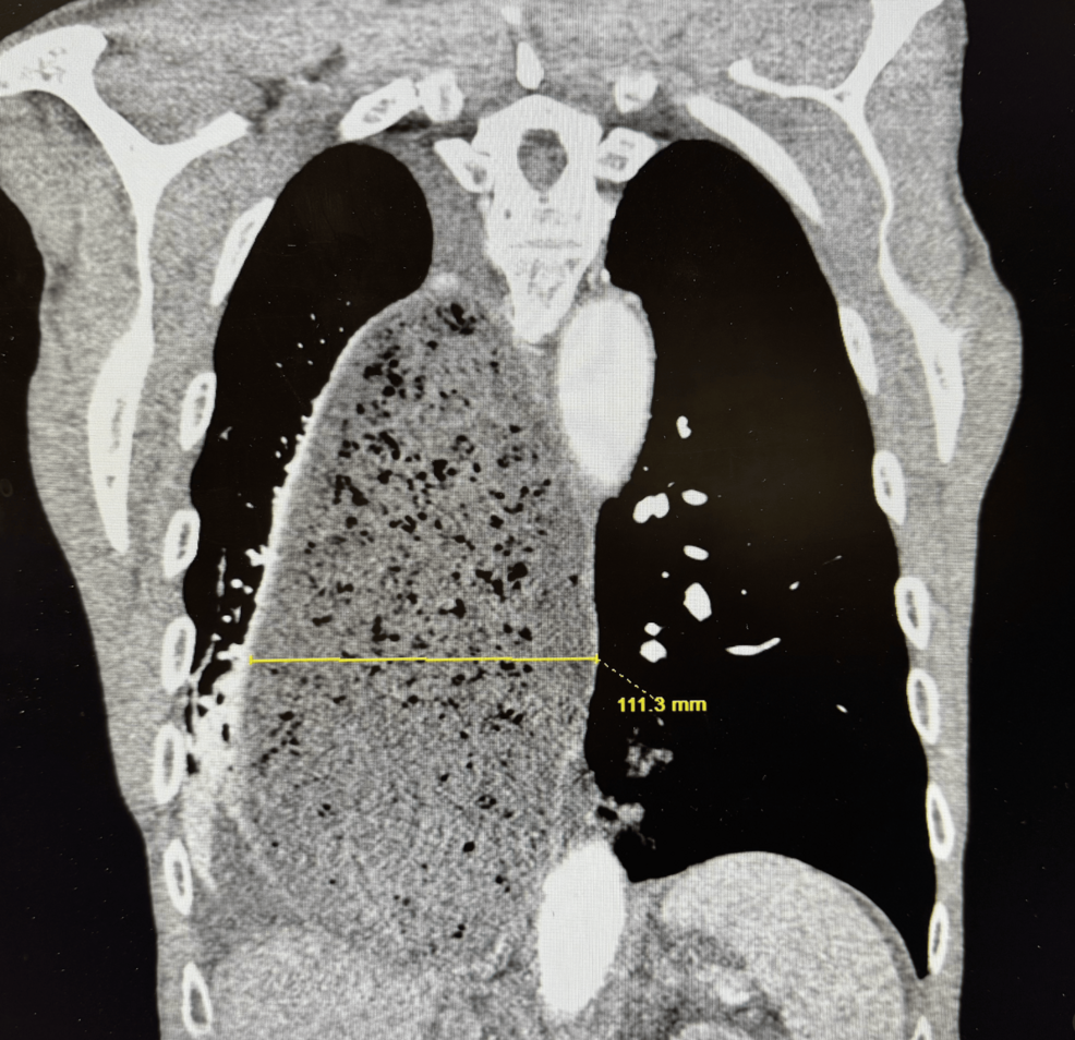 Can’t Stomach It: A Dilated Tale of Achalasia