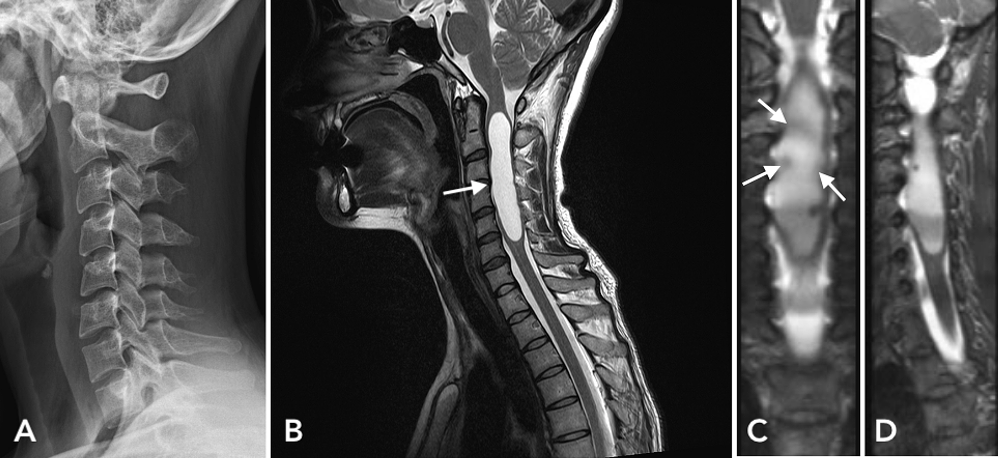 Cureus Multicentric Spinal Pilocytic Astrocytoma Presenting with Syringomyelia