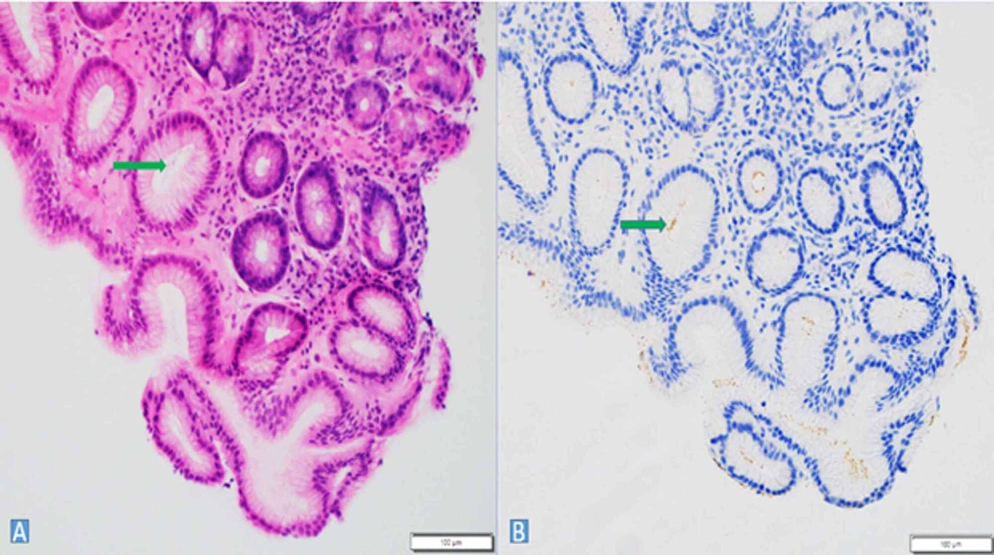 Cureus Persistent Helicobacter Pylori Infection An Insight To The Limitations Of Current Clinical Practice