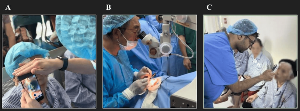 L’importance de la chirurgie de la cataracte de haute qualité: un cas d’amélioration objective des résultats après la chirurgie dans un hôpital rural du Vietnam