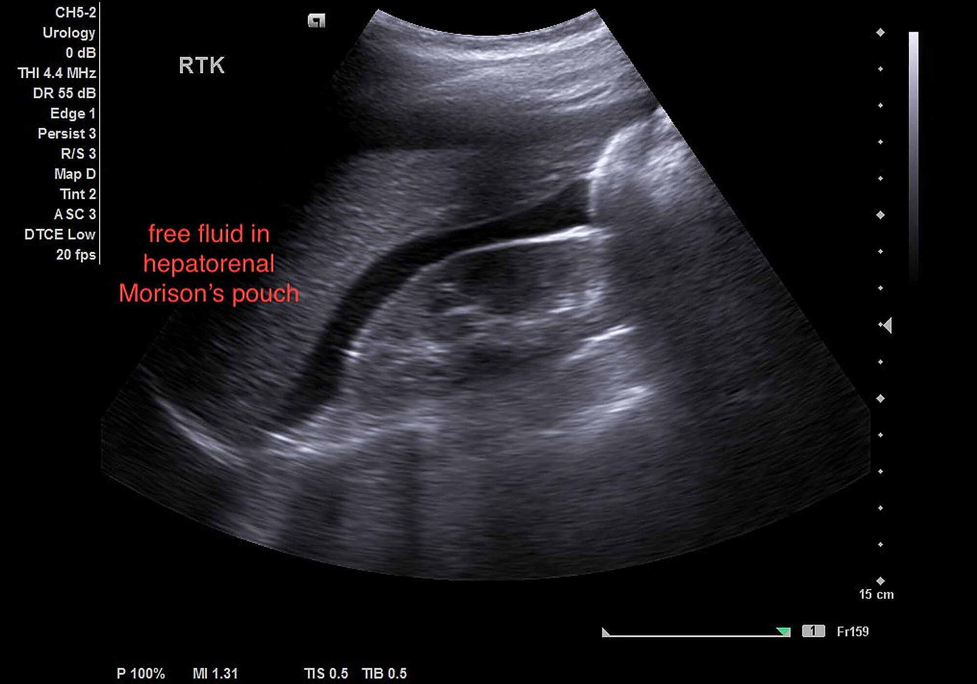 Cureus | Ruptured Heterotopic Pregnancy: A Rare Encounter in Acute ...