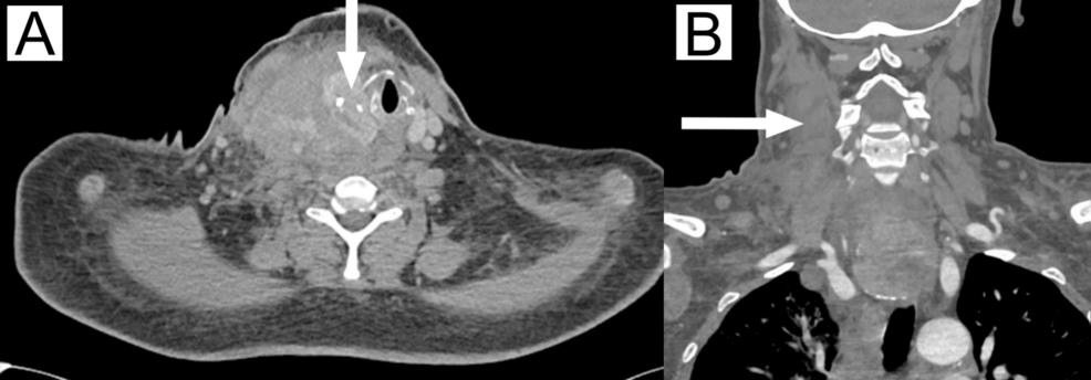 bpc-157 thyroid reddit Cervicomediastinal Hematoma From Inferior Thyroid Artery Injury After  Attempted Permanent Dialysis Catheter Placement Without Ultrasound Guidance