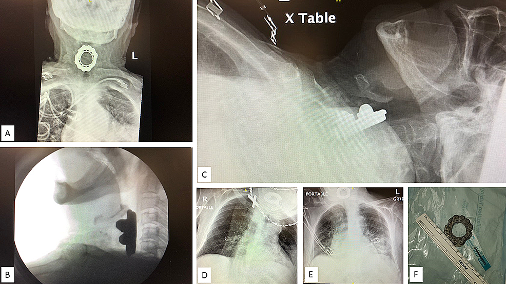 Comparative-Chest-and-Neck-Radiographs-With-Foreign-Body-in-Place-vs-Extracted