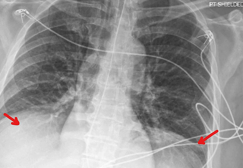 Cureus | Miller Fisher Syndrome in the COVID-19 Era – A Novel Target