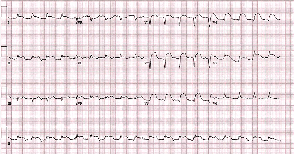 Cureus | Spontaneous Coronary Artery Dissection of the Left Main ...