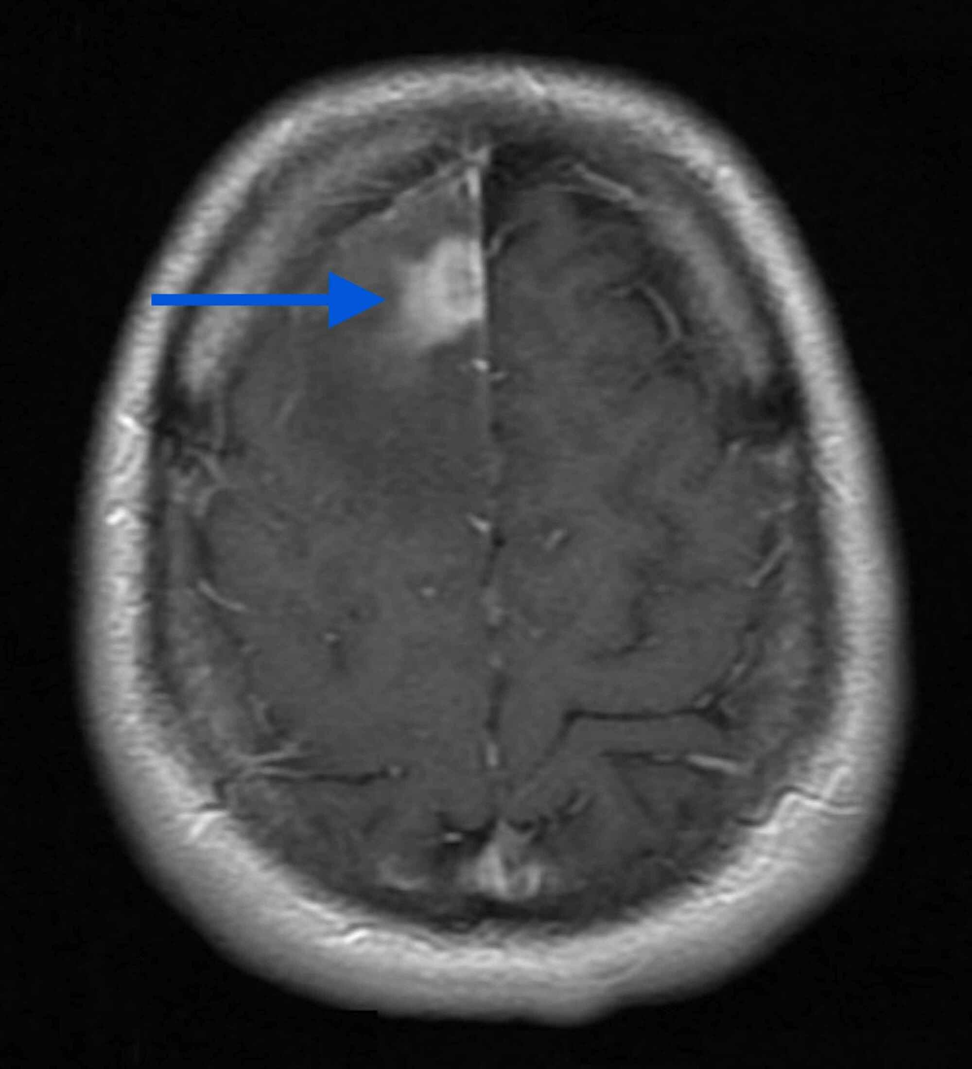 Cureus Neurocysticercosis An Easy to Miss Diagnosis in NonEndemic