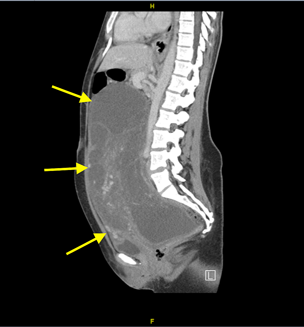 Cureus | Aggressive Angiomyxoma of the Posterior Wall of the Uterus