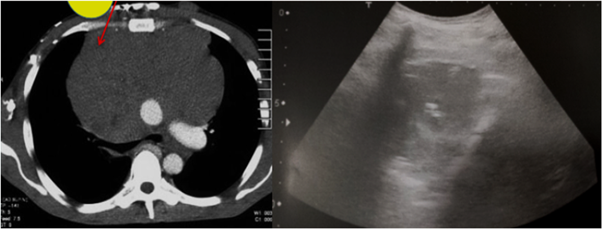 cureus-ultrasound-guided-transthoracic-mediastinal-biopsy-a-safe