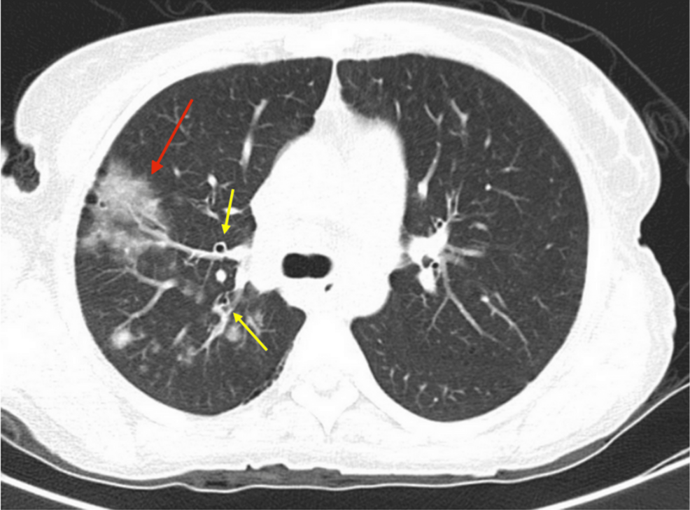 AIDS Treatment Barriers Leading to Multiple Infections and Hospice: A Case Study