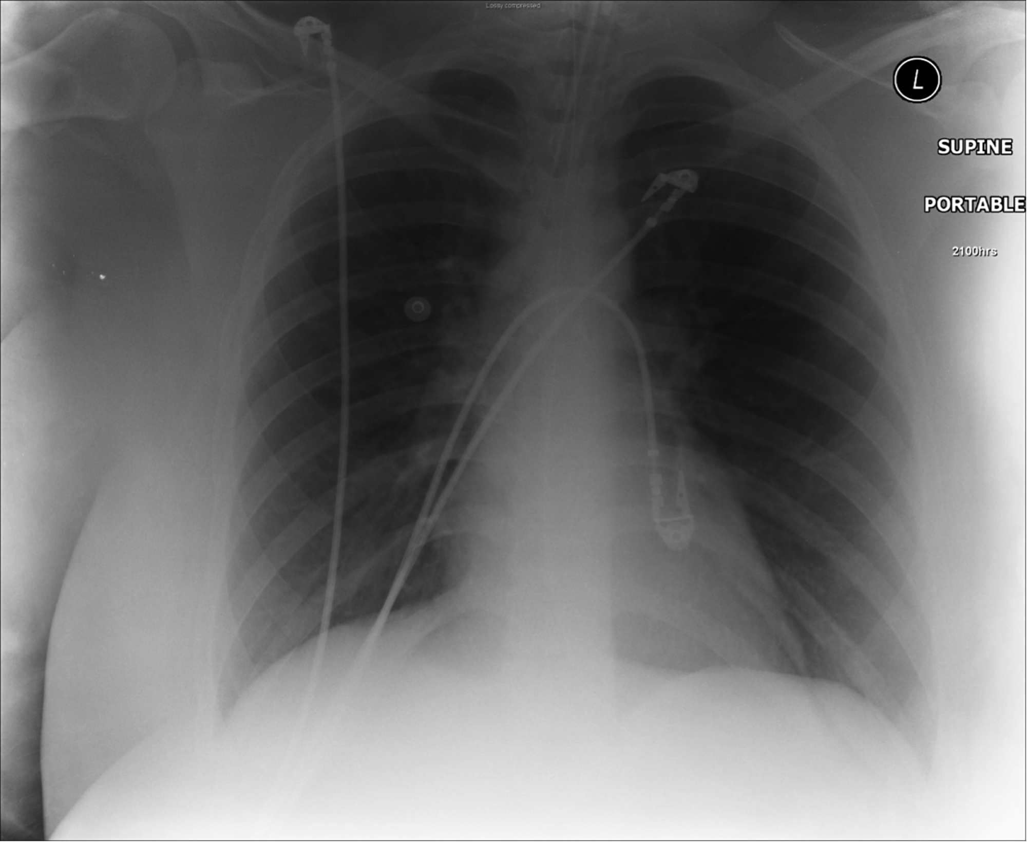 Asthma Chest X Ray