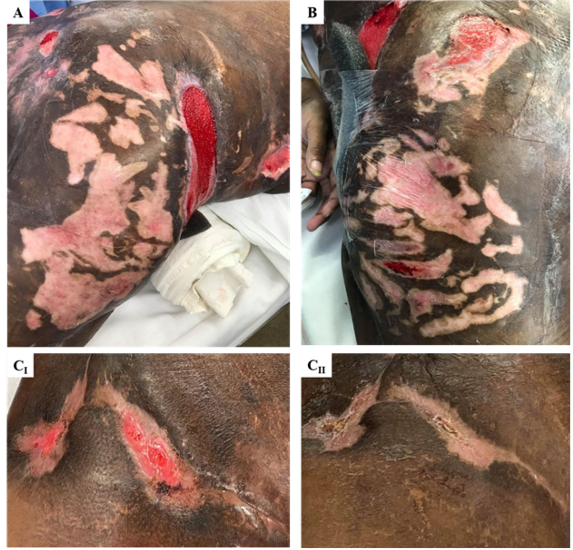 calciphylaxis ulcers