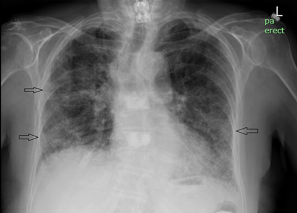 Cureus SertralineInduced Acute Eosinophilic Pneumonia