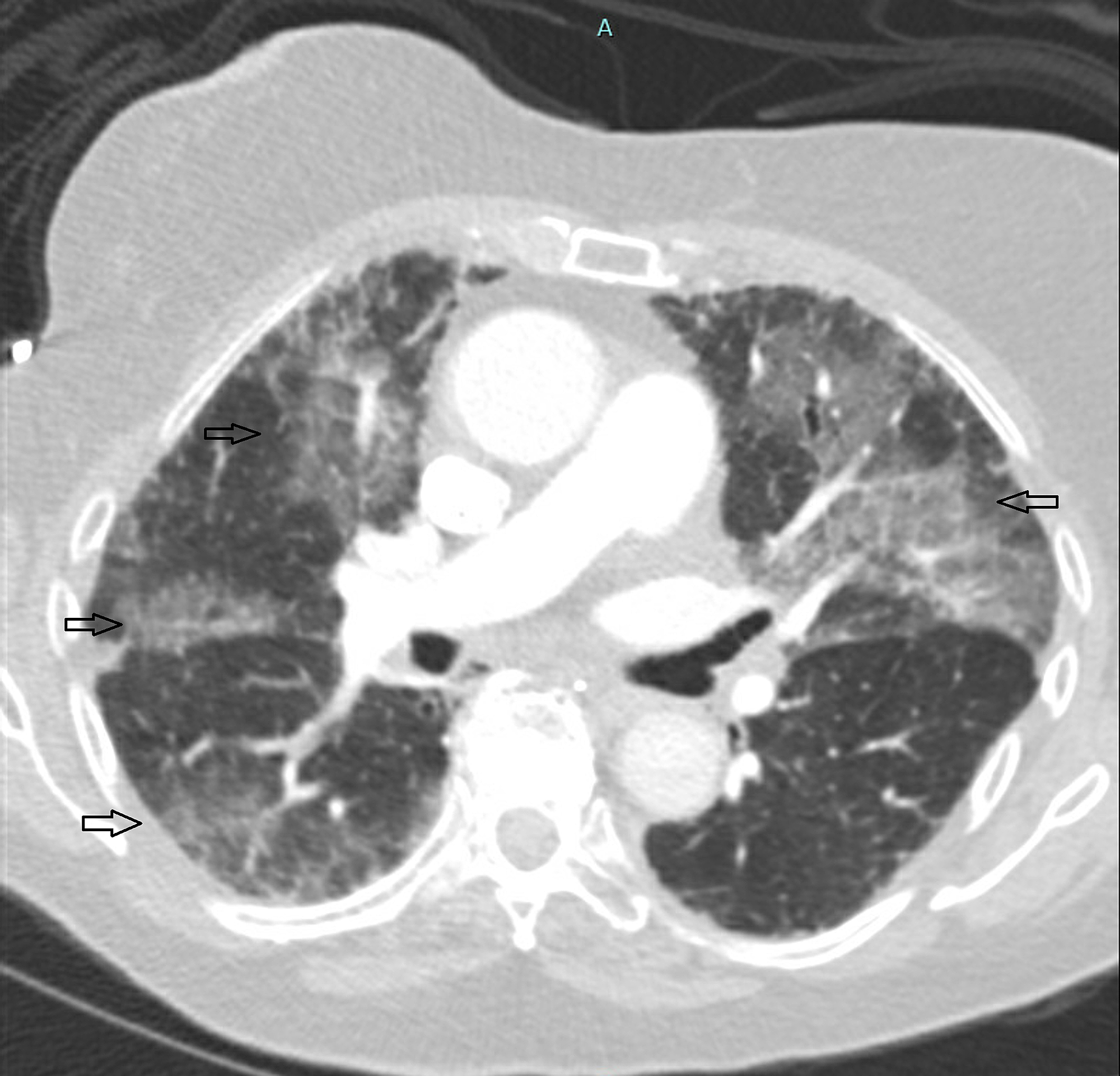 Cureus SertralineInduced Acute Eosinophilic Pneumonia
