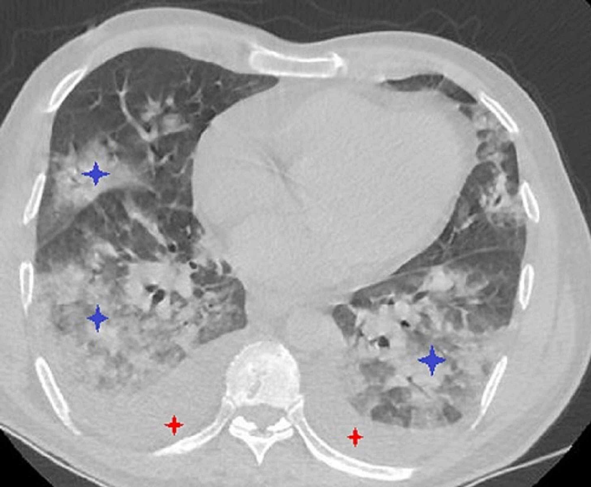 Cureus AntiGlomerular Basement Membrane Disease as a Potential