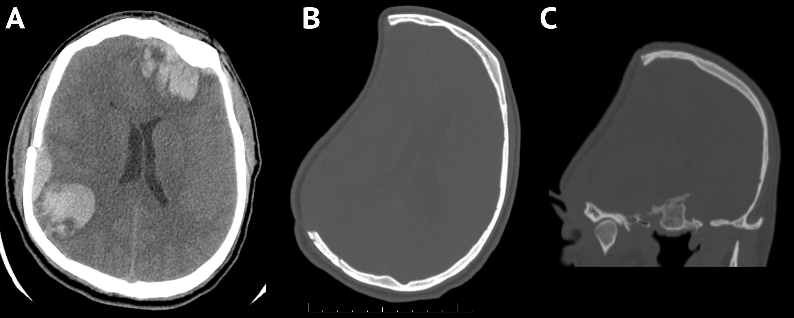 Cranioplasty: Technical Note Temporalis Muscle · PDF fileAttribution ...