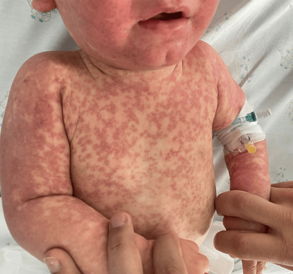 Mono Rash: Different Types, Symptoms, and Treatment, image size:986x922