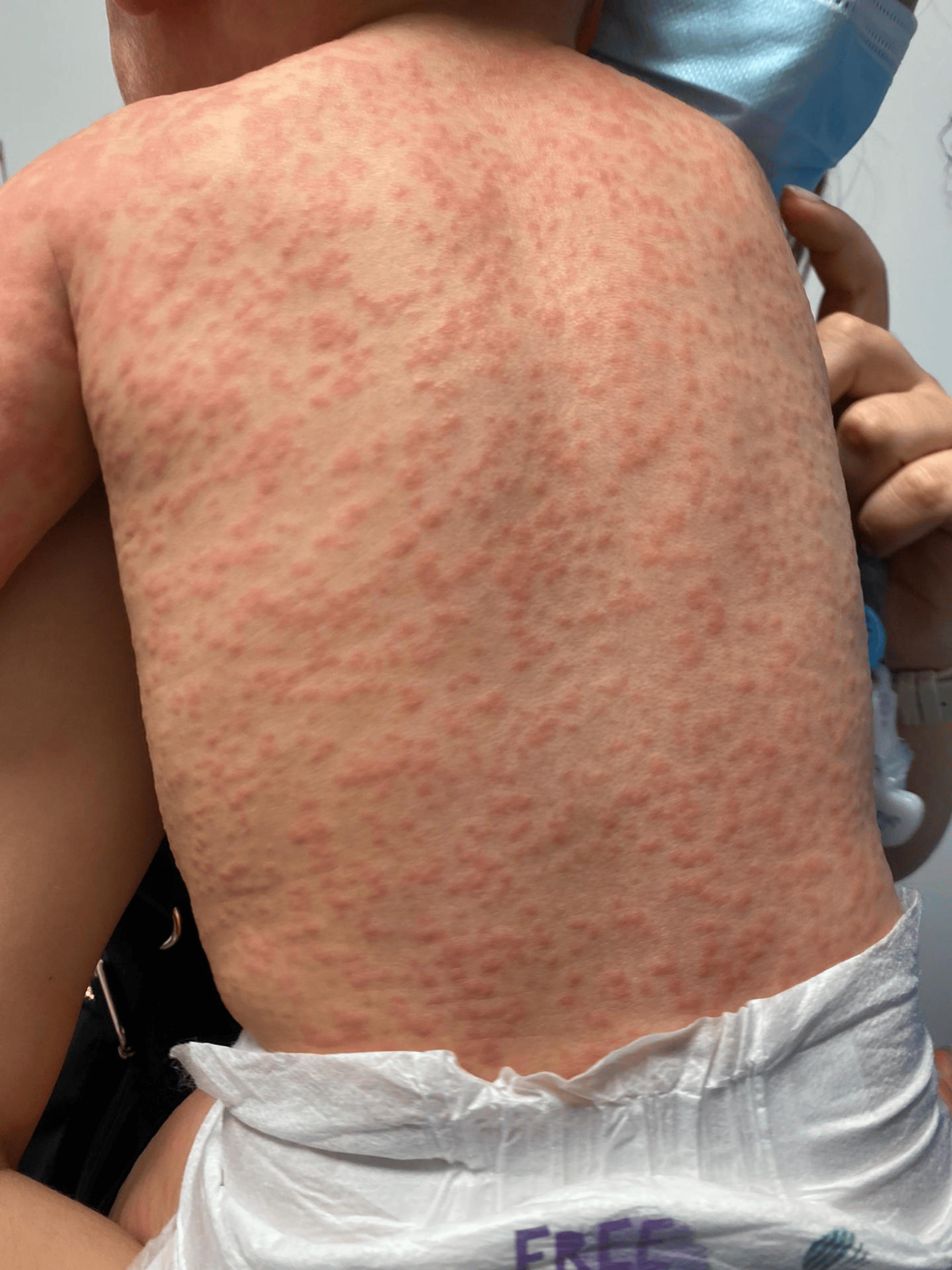Mononucleosis infectious - Altmeyers Encyclopedia - Department Dermatology, image size:3000x4000