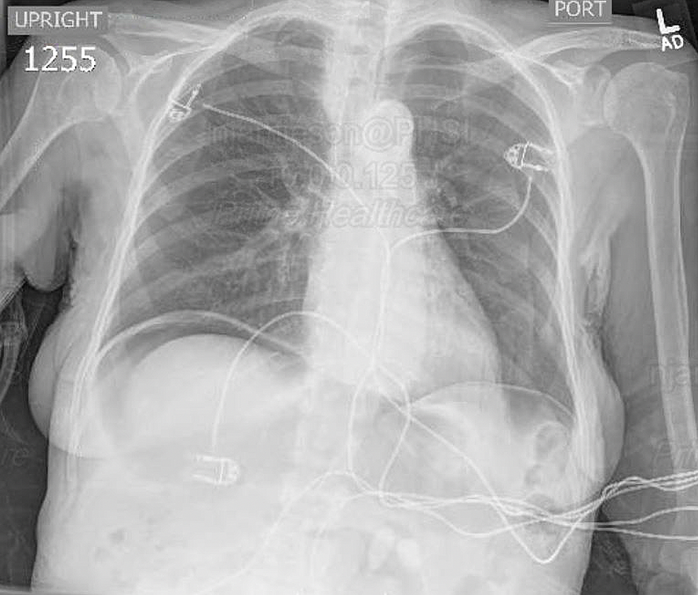 Emergent Repair of a Perforated Giant Duodenal Ulcer in a