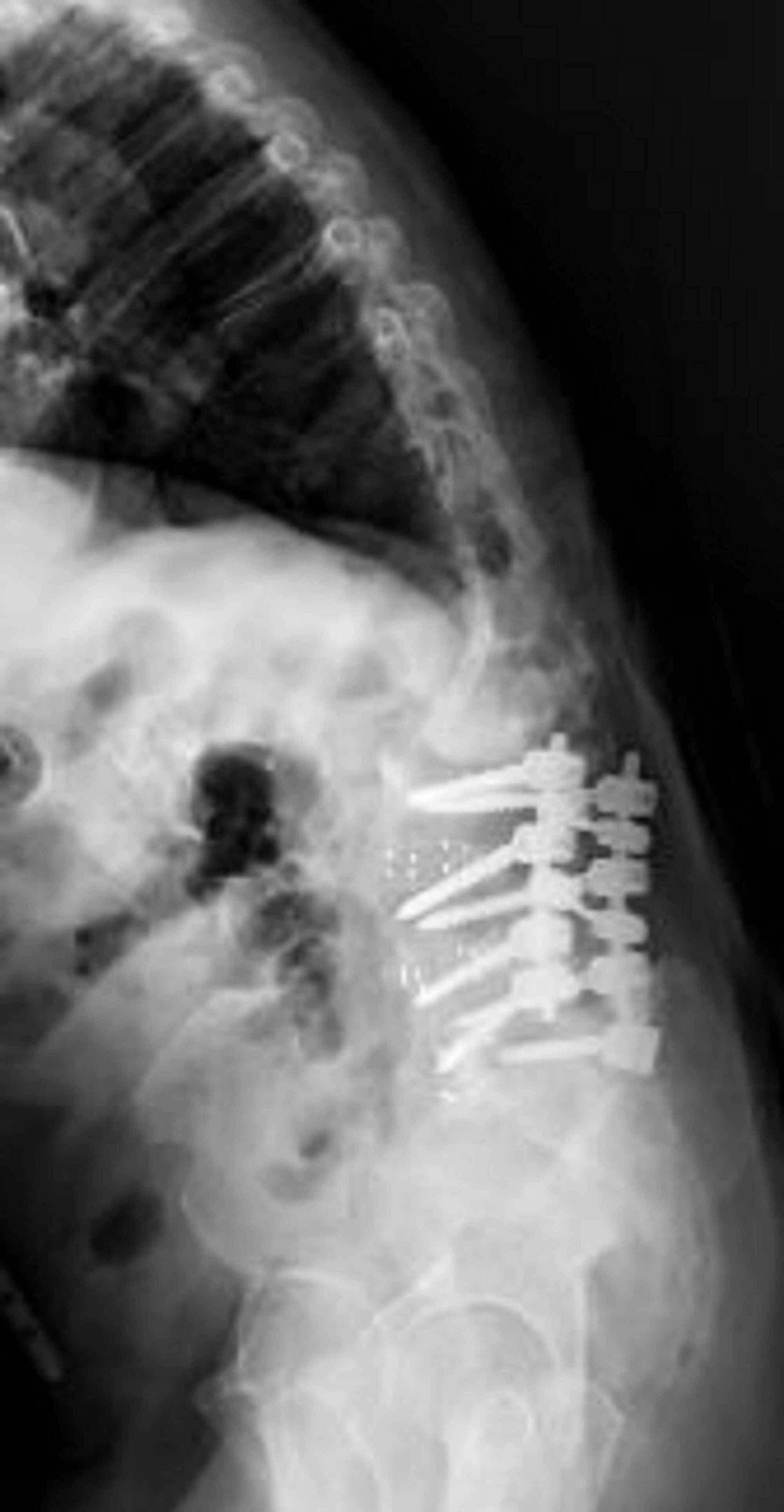 Cureus The “Kickstand Rod” Technique for Coronal Imbalance in