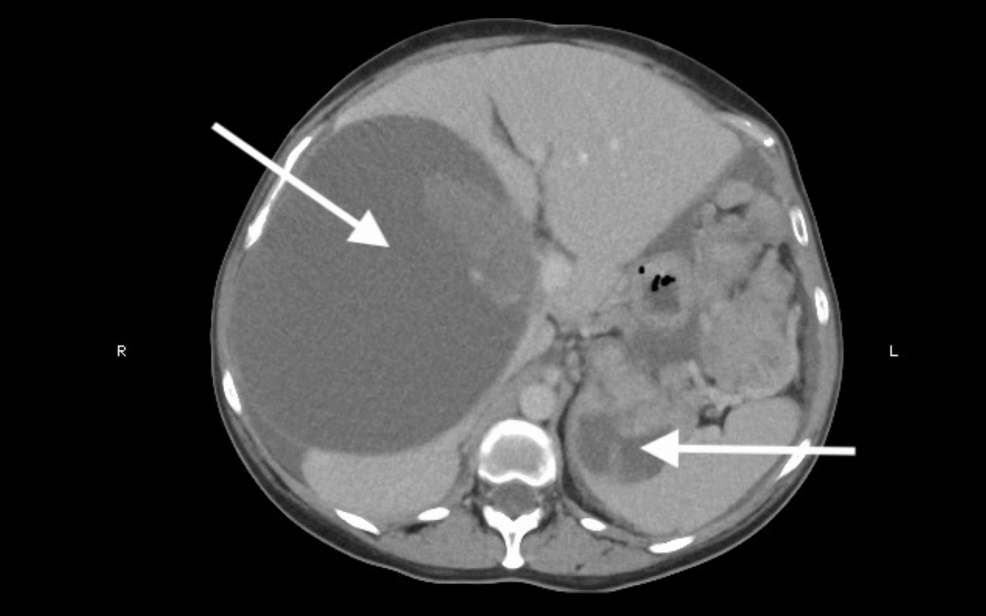Delayed Relapse of Gastric Gastrointestinal Stromal Tumor After 17 Years: A Case Report and Review of Surveillance Challenges