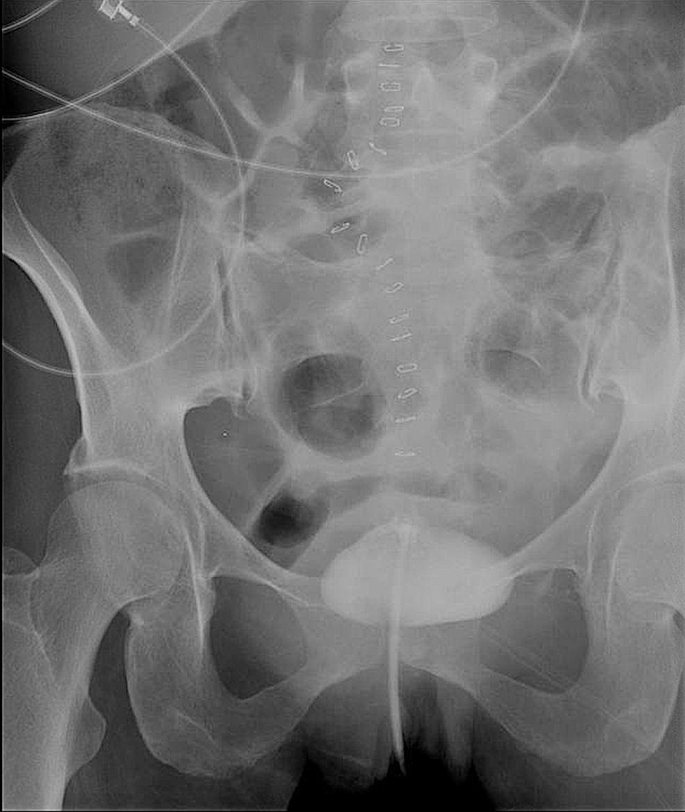 cureus-colovesical-fistula-an-unusual-complication-of