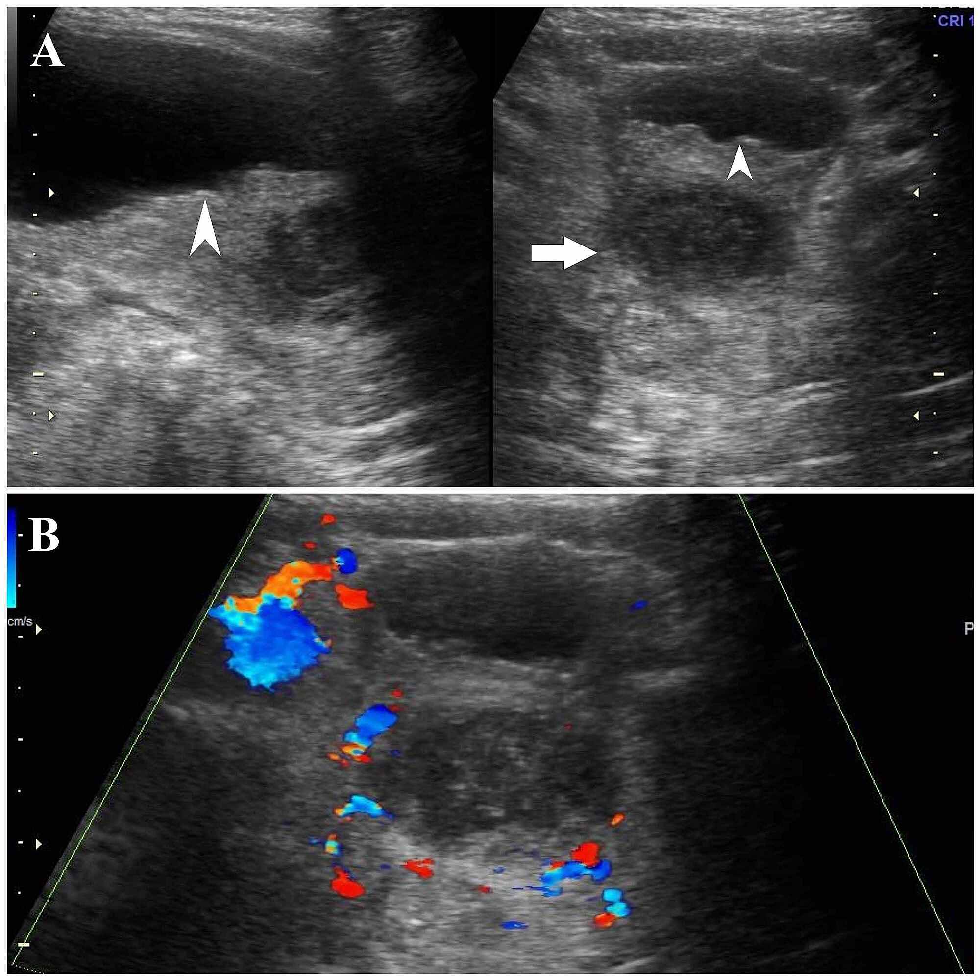 enlarged prostate ultrasound