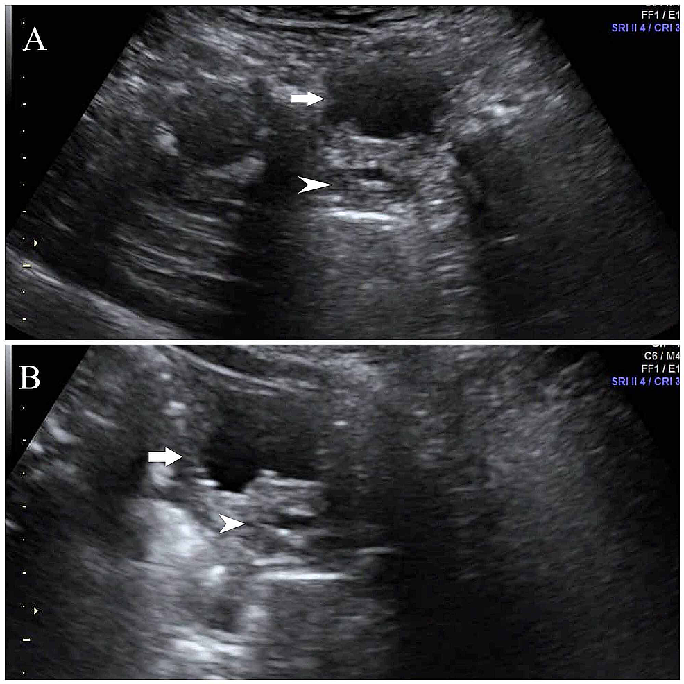 Cureus | Prostatic Abscess in a Neonate