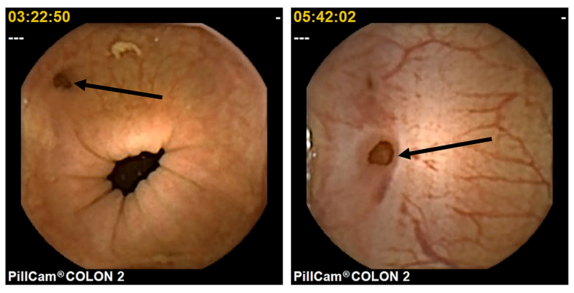 Cureus Colon Capsule Endoscopy in Detecting Colonic Diverticula in a