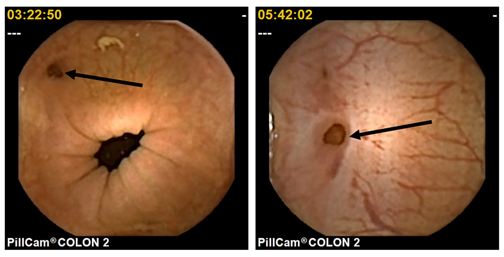 cureus-colon-capsule-endoscopy-in-detecting-colonic-diverticula-in-a