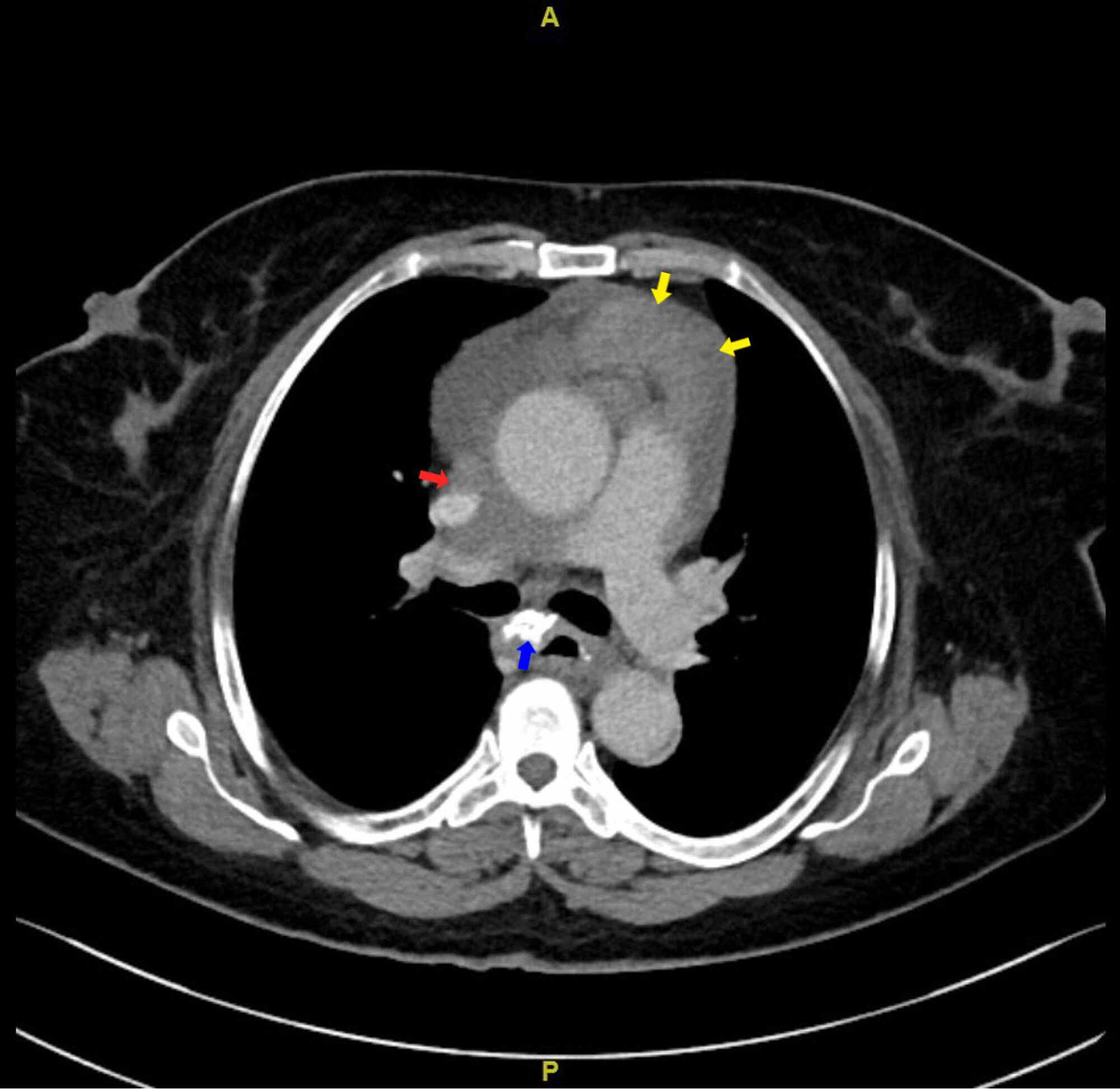 Cureus Intermittent Superior Vena Cava Syndrome Secondary To