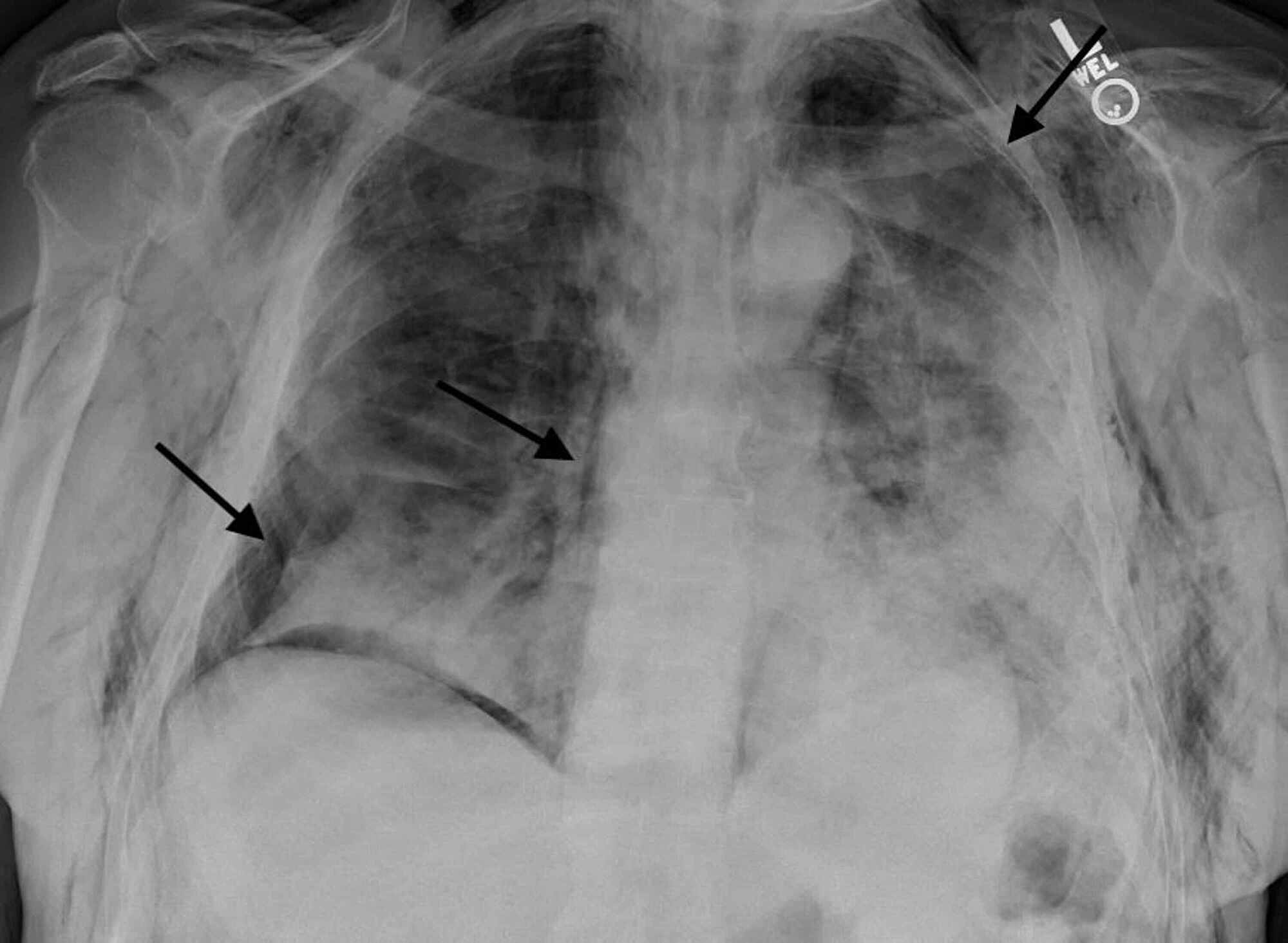 Normal x ray chest image