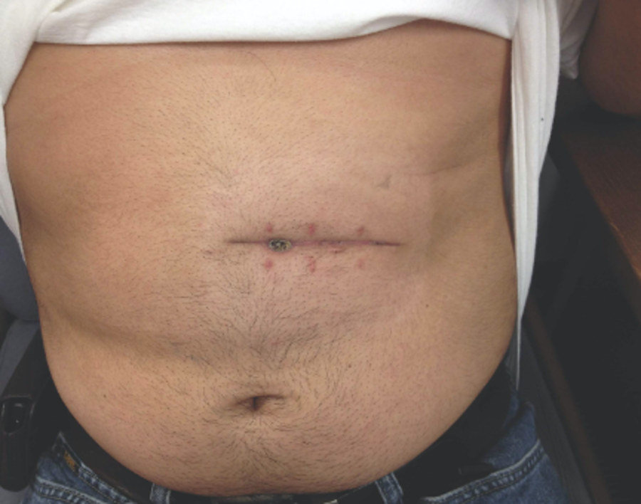 Cureus Pelvic Outlet Obstruction Secondary to Salmonella enterica