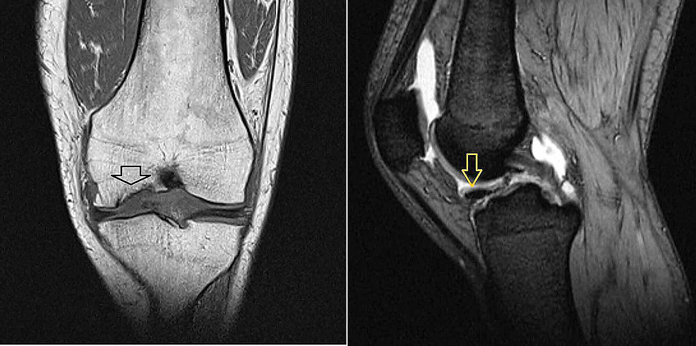 Cureus | Microfracture Technique for Chronic Unstable Osteochondral ...