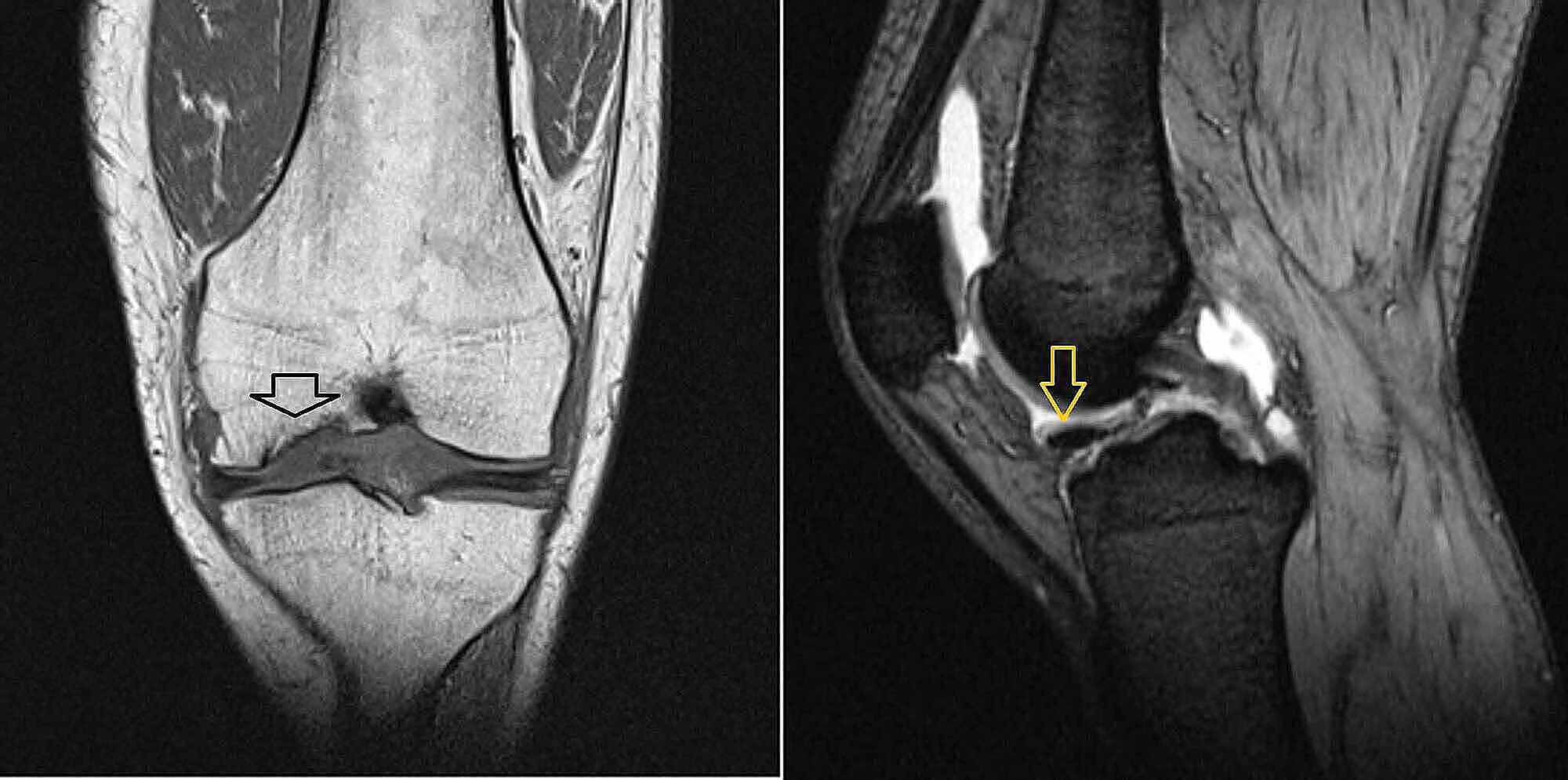 Cureus | Microfracture Technique for Chronic Unstable Osteochondral ...