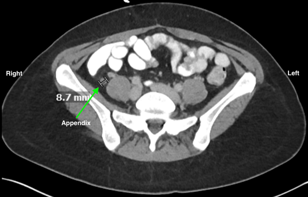 Diverticular Disease of the Appendix: A Rarely Identified Pathology Prior to Surgery