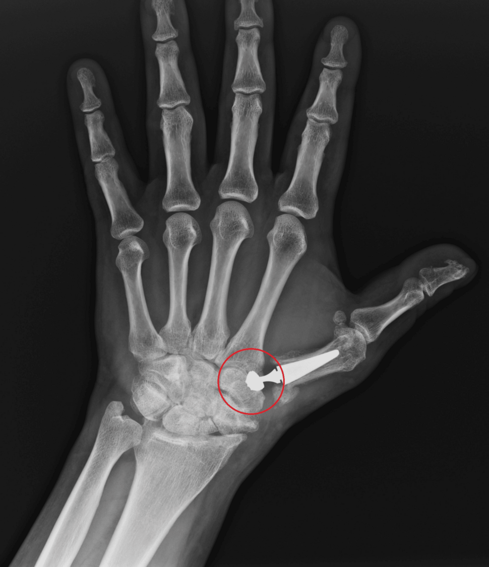 Rolando Fracture Complication After Nonstandard Surgical Treatment | Cureus