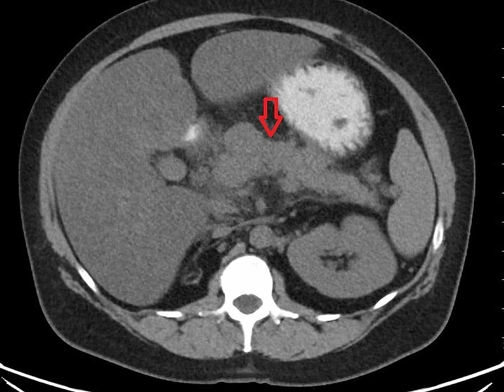 Cureus Fulminant Pancreatitis Due To Disseminated Histoplasmosis Case Report And Literature Review Cureus Fulminant Pancreatitis Due To Disseminated Histoplasmosis Case Report And Literature Review