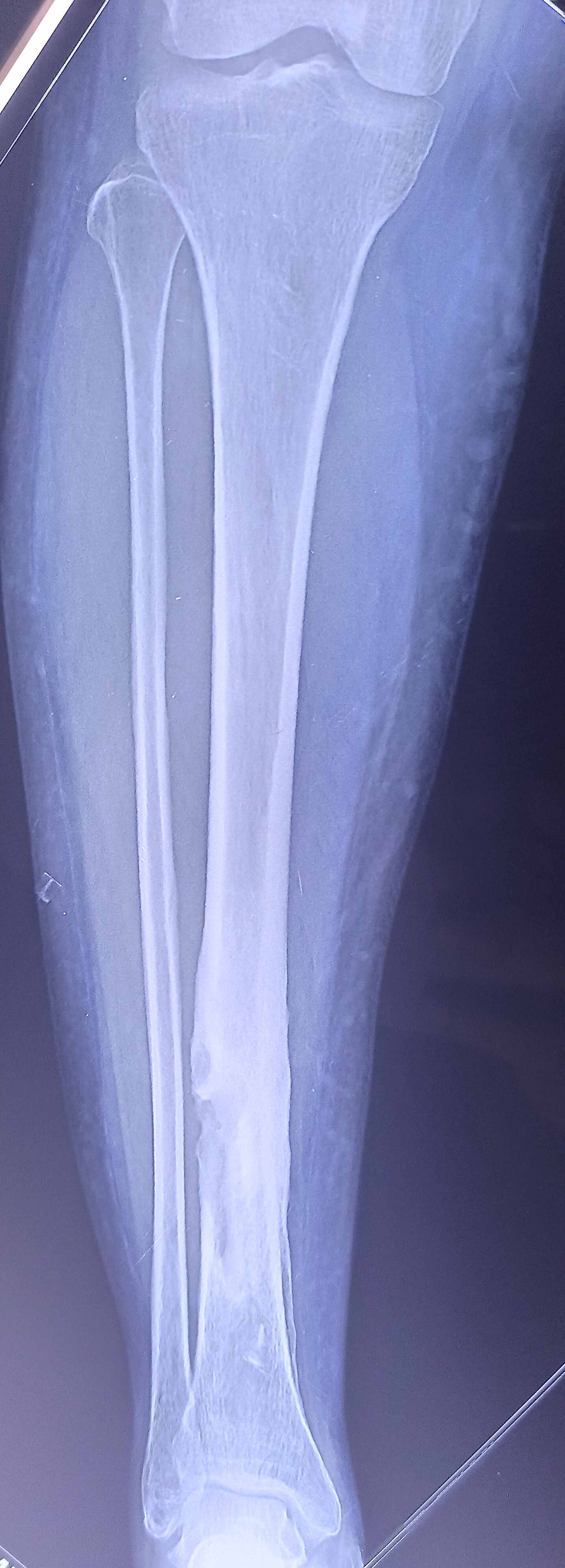 Cureus A Case Report of Salmonella Typhi Osteomyelitis With