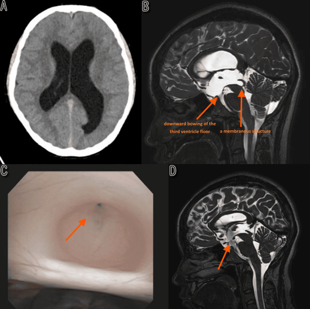 Neuroendoscopic Diagnosis and Treatment of Adolescent-Onset Aqueductal  Stenosis: A Report of Two Cases Demonstrating the Utility of Endoscopic  Third Ventriculostomy | Cureus, image size:986x984