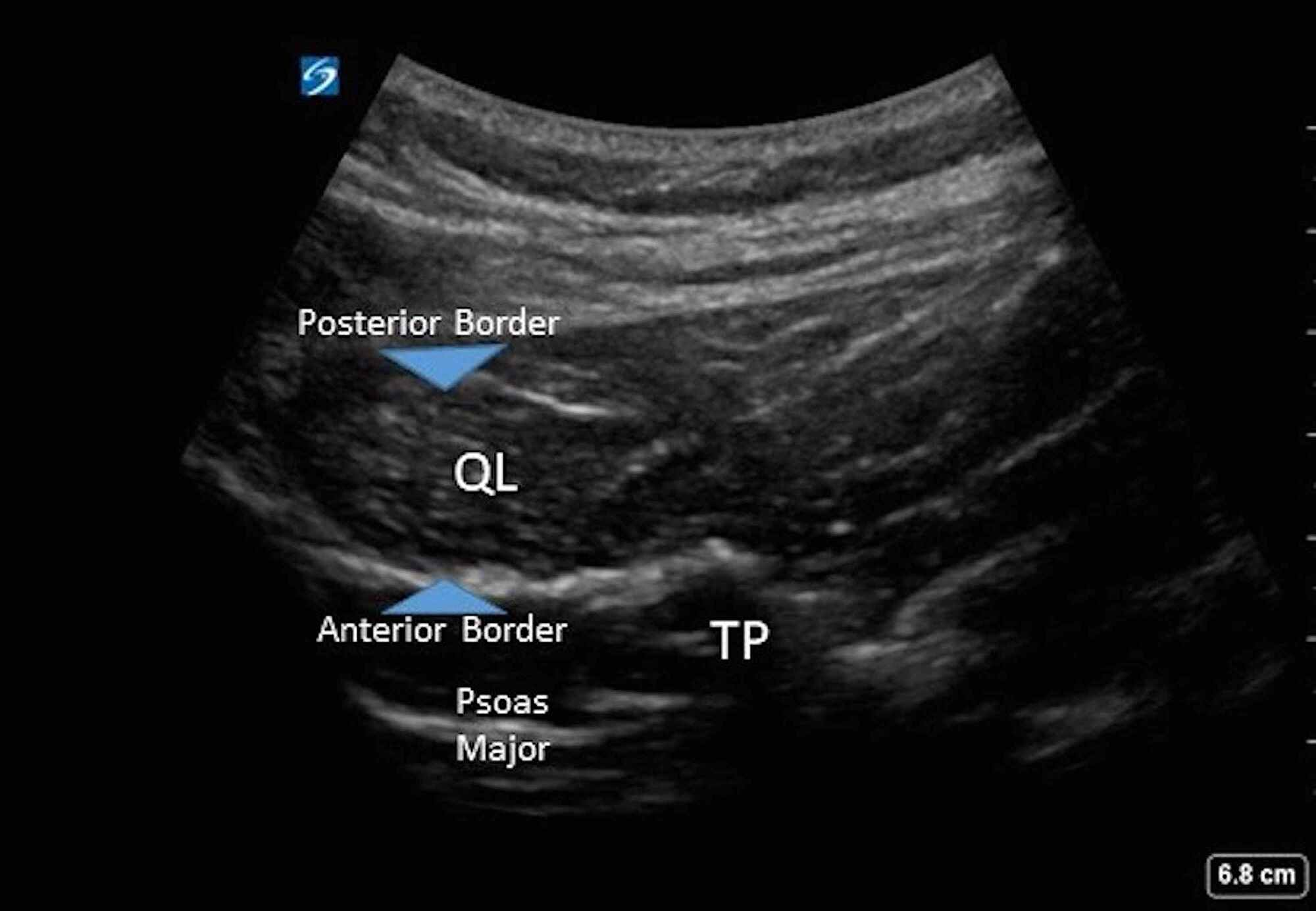 Cureus Pericapsular Nerve Group (PENG) Block in Combination With the