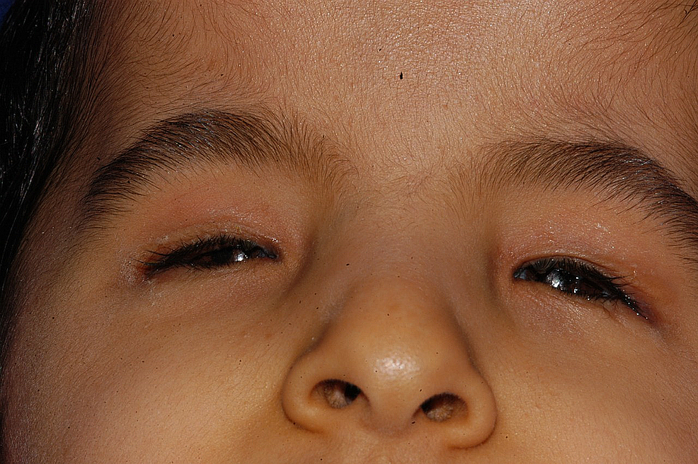 Child-with-a-prosthesis-in-both-orbits-two-years-after-enhancing-the-anophthalmic-orbit-with-confirmers