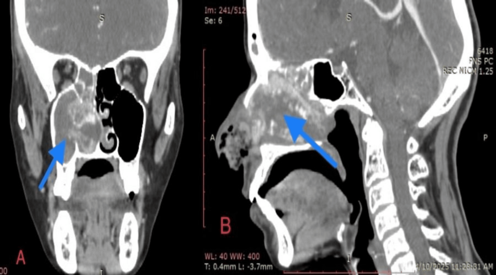 Sinonasal Lobular Capillary Hemangioma of the Nasal Cavity: A Rare Giant Vascular Tumor Managed With Preoperative Embolization and Medial Maxillectomy