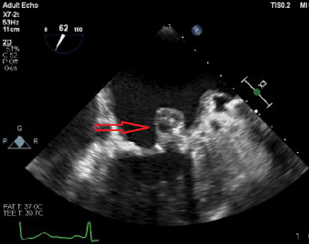 Two-chamber-view-showing-abscess-of-mitral-leaflet-(red-arrow)